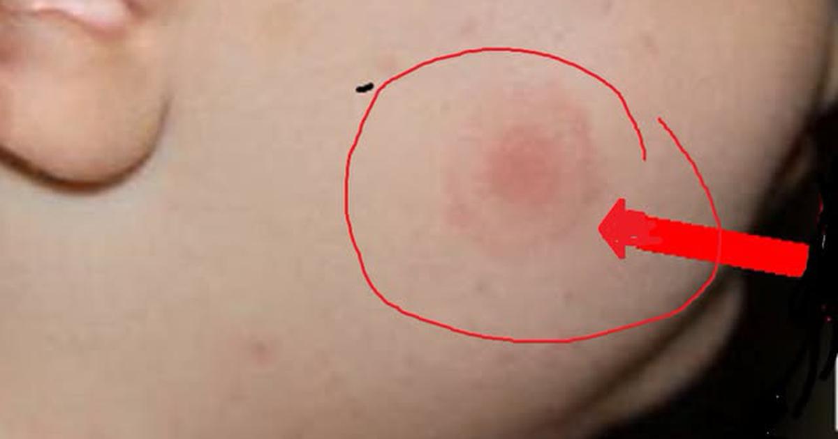 Doctorul Tudor Ciuhodaru: Ce trebuie să știți (să faceți) în cazul mușcăturilor de căpușe